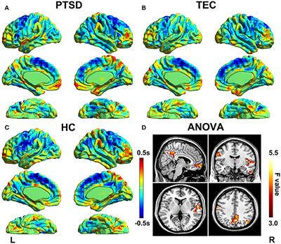 The Temporal Propagation of Intrinsic Brain Activity Associate With the Occurrence of PTSD